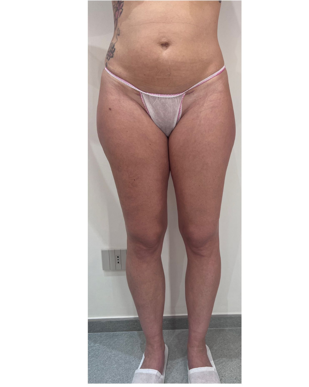 Confronto prima e dopo di gambe e cosce