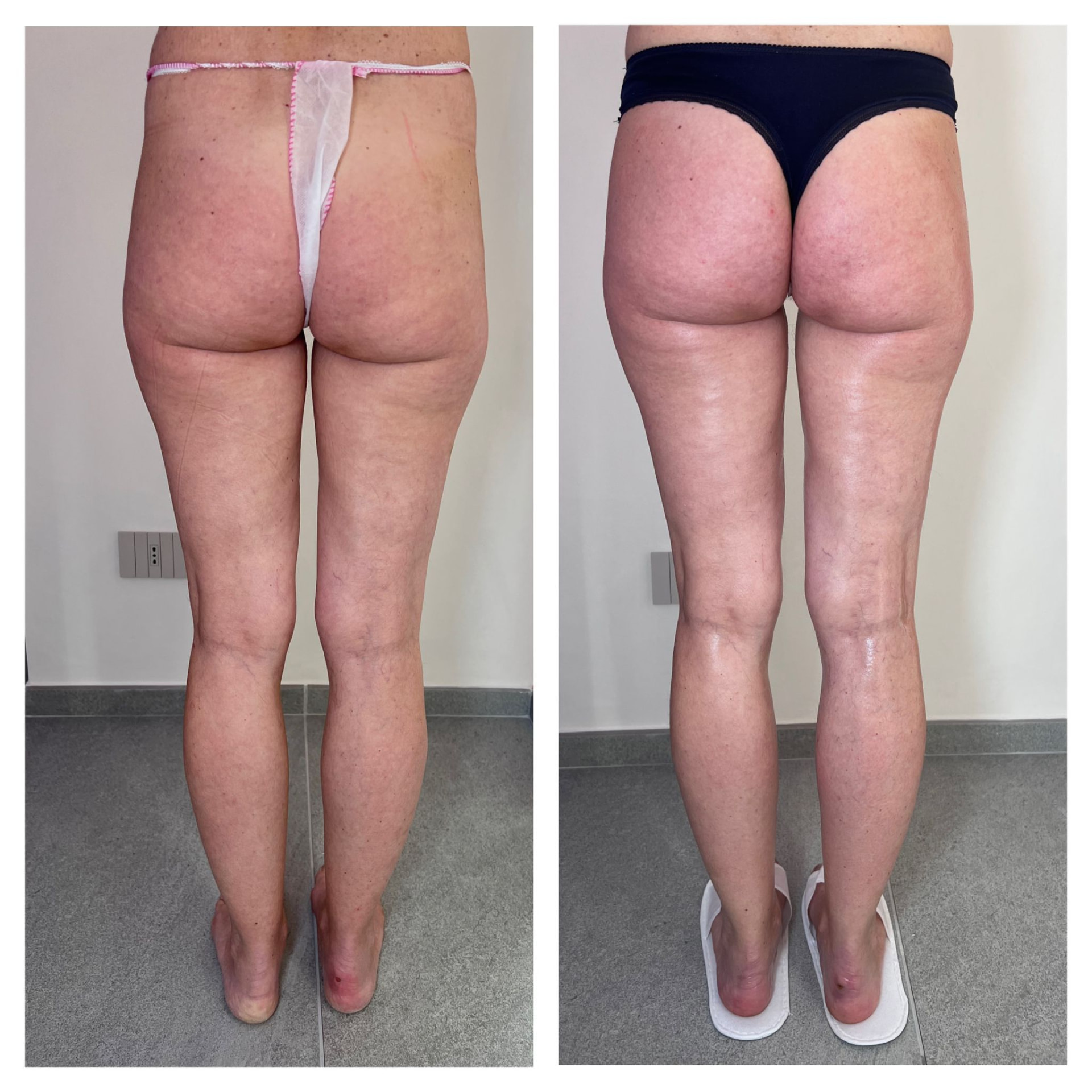 Confronto prima e dopo di gambe e glutei